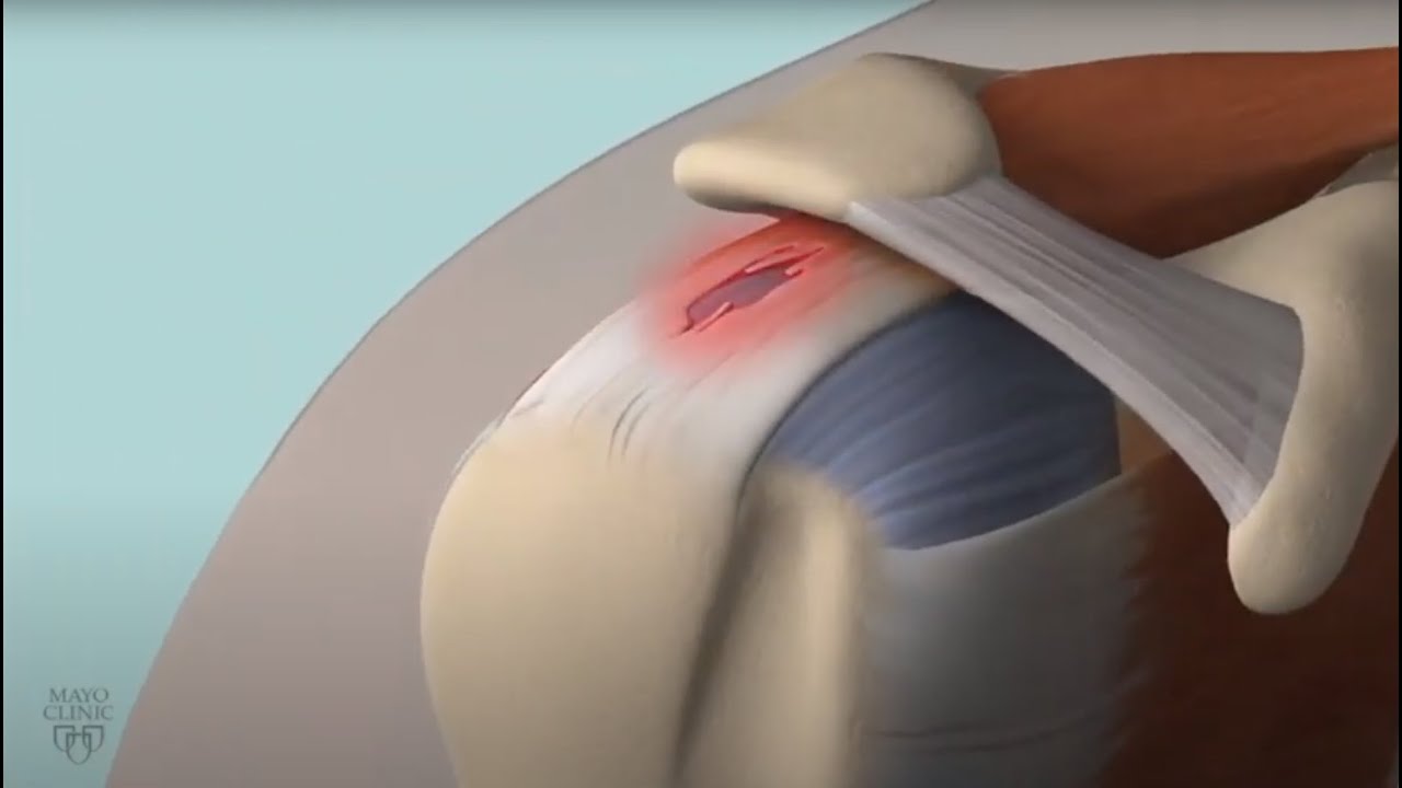 Learn About Rotator Cuff Damage
