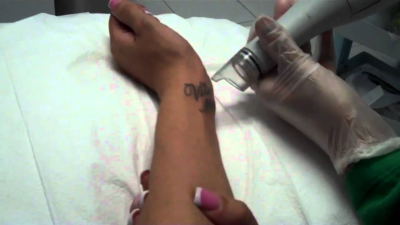 CAPRI TATT REMOVAL
