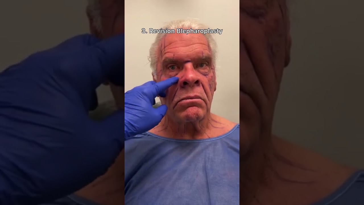 Major Male Facelift Transformation! Watch until the end 😱😍